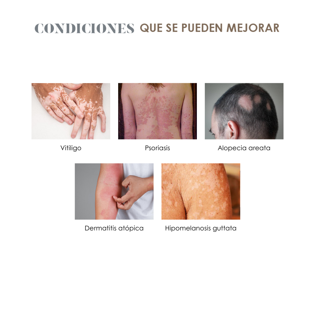 Eximal mini (Lámpara Excimer 308nm)