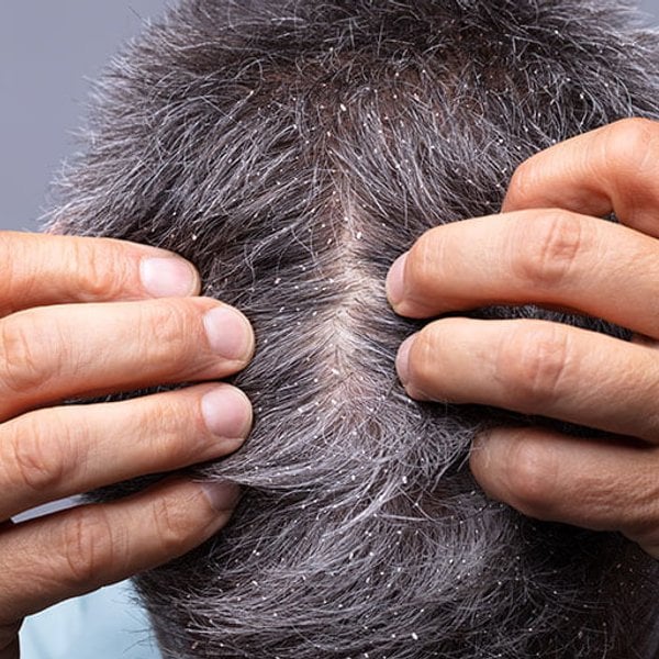 Caspa y Dermatitis Seborréica