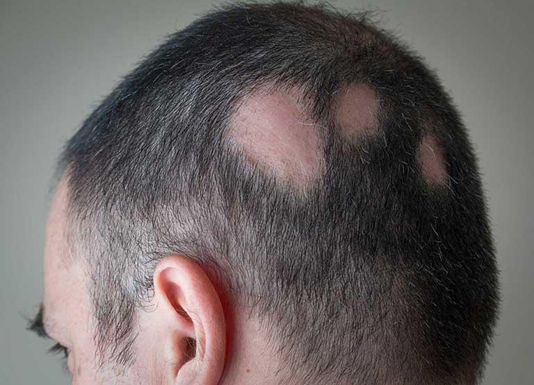 Caída de Pelo